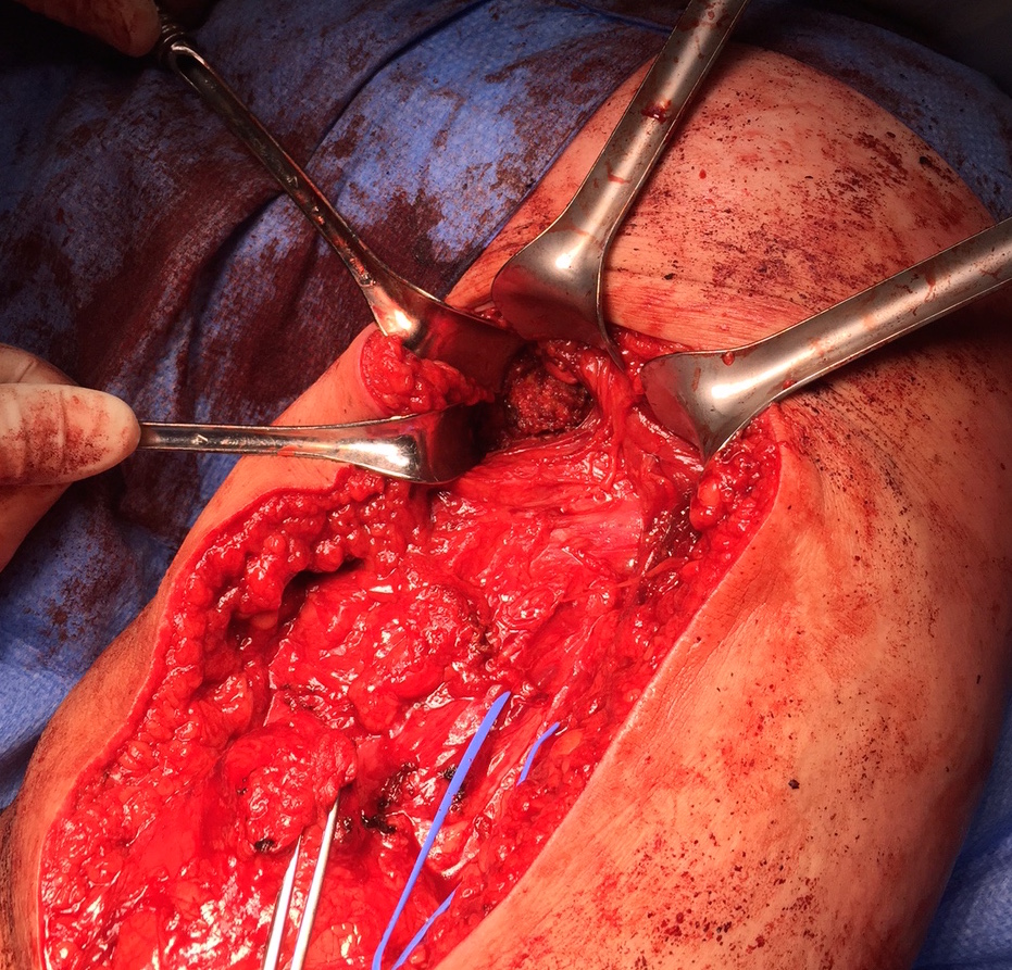 Drill hole ischial tuberosity